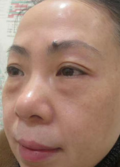 去眼袋手术