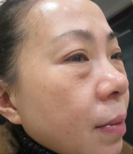 去眼袋手术