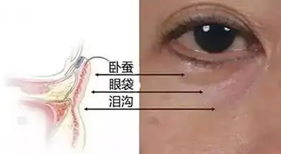 去眼袋手术