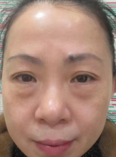 去眼袋手术