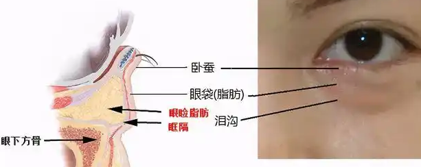 去眼袋手术