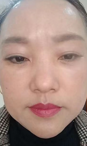 去眼袋手术