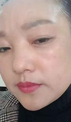 去眼袋手术