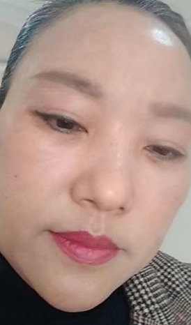 去眼袋手术