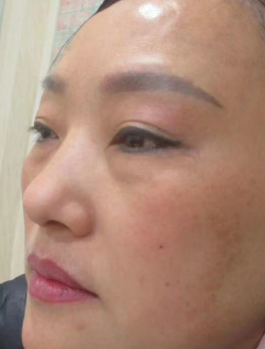 去眼袋手术