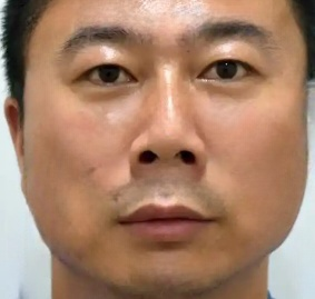 去眼袋手术