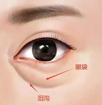 去眼袋手术