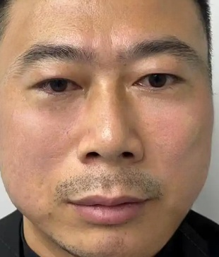 去眼袋手术