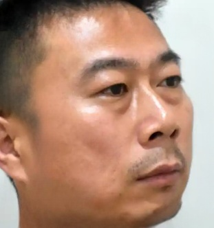 去眼袋手术