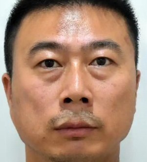 去眼袋手术