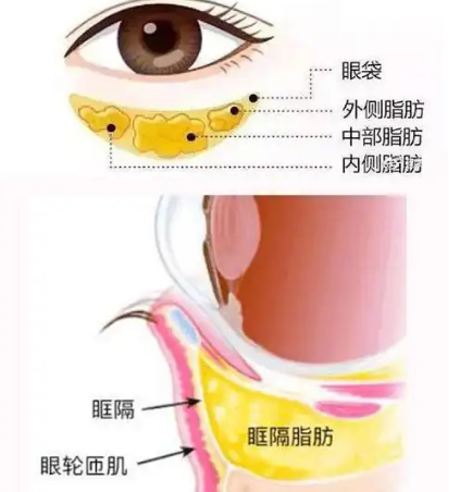 去眼袋手术