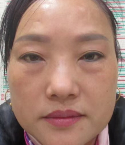 去眼袋手术