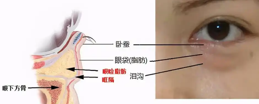 眼袋