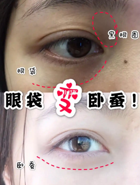 眼袋