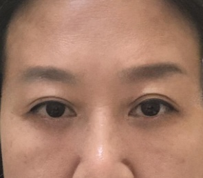 去眼袋手术