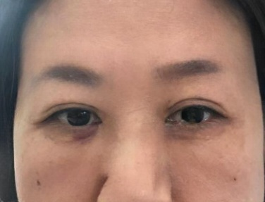 去眼袋手术