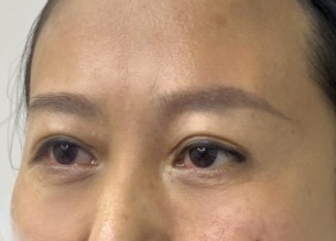 去眼袋手术