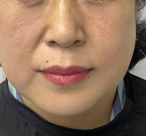 去眼袋手术