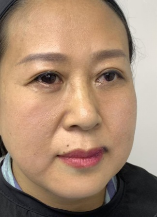 去眼袋手术