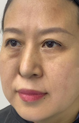 去眼袋手术