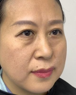 去眼袋手术