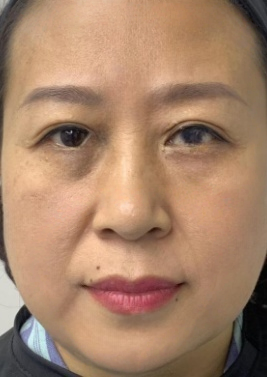 去眼袋手术