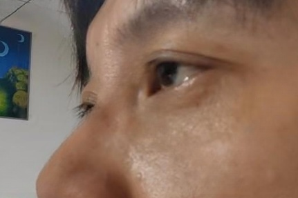 去眼袋手术