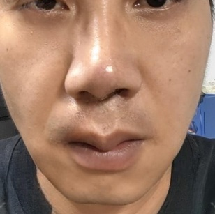 去眼袋手术