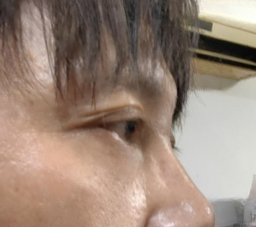 去眼袋手术