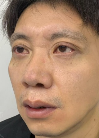 去眼袋手术