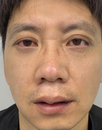 去眼袋手术