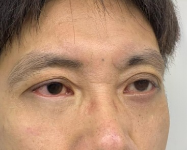 去眼袋手术