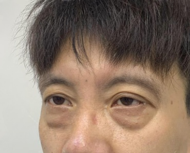 去眼袋手术