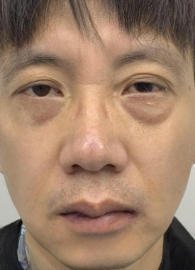 去眼袋手术