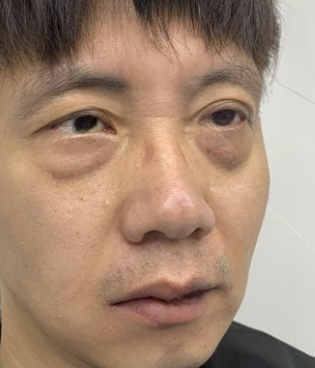 去眼袋手术