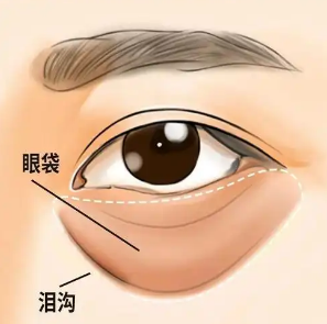 去眼袋手术