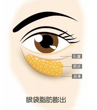 去眼袋手术