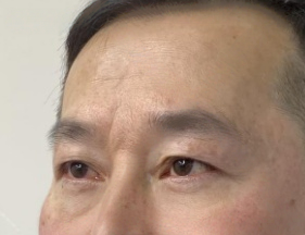 去眼袋手术