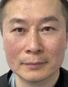 去眼袋手术