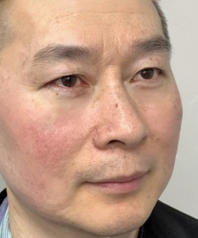 去眼袋手术