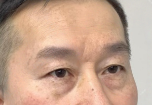 去眼袋手术