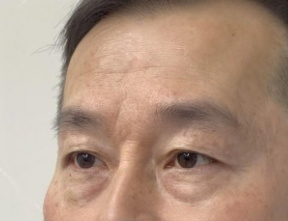 去眼袋手术
