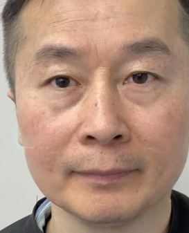 去眼袋手术