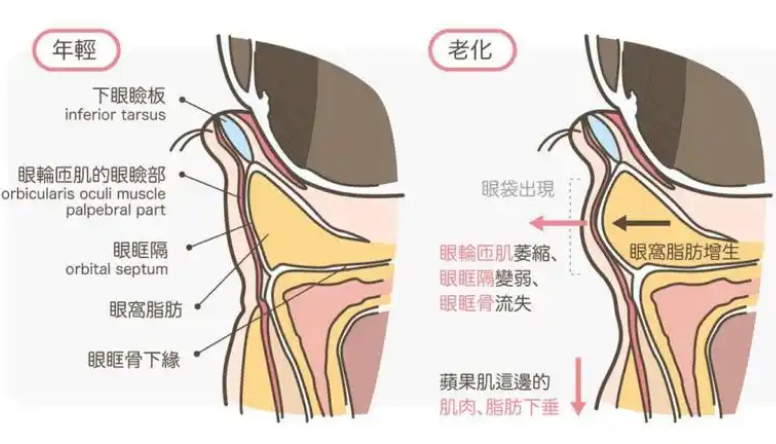 去眼袋手术