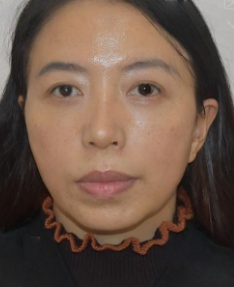 去眼袋手术