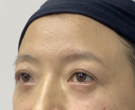 去眼袋手术