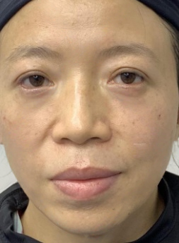 去眼袋手术