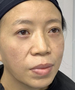 去眼袋手术