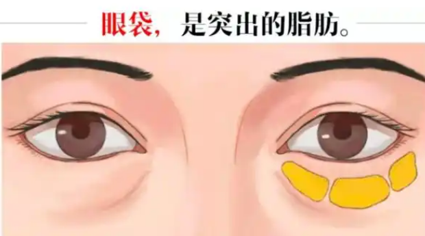 去眼袋手术