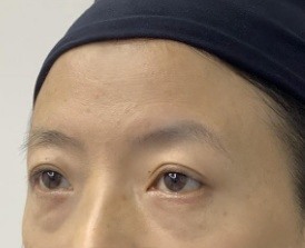 去眼袋手术
